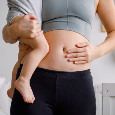Frau mit Kind auf dem Arm überlegt, wann der rochtige Zeitpunkt für eine Bauchdeckenstraffung ist.